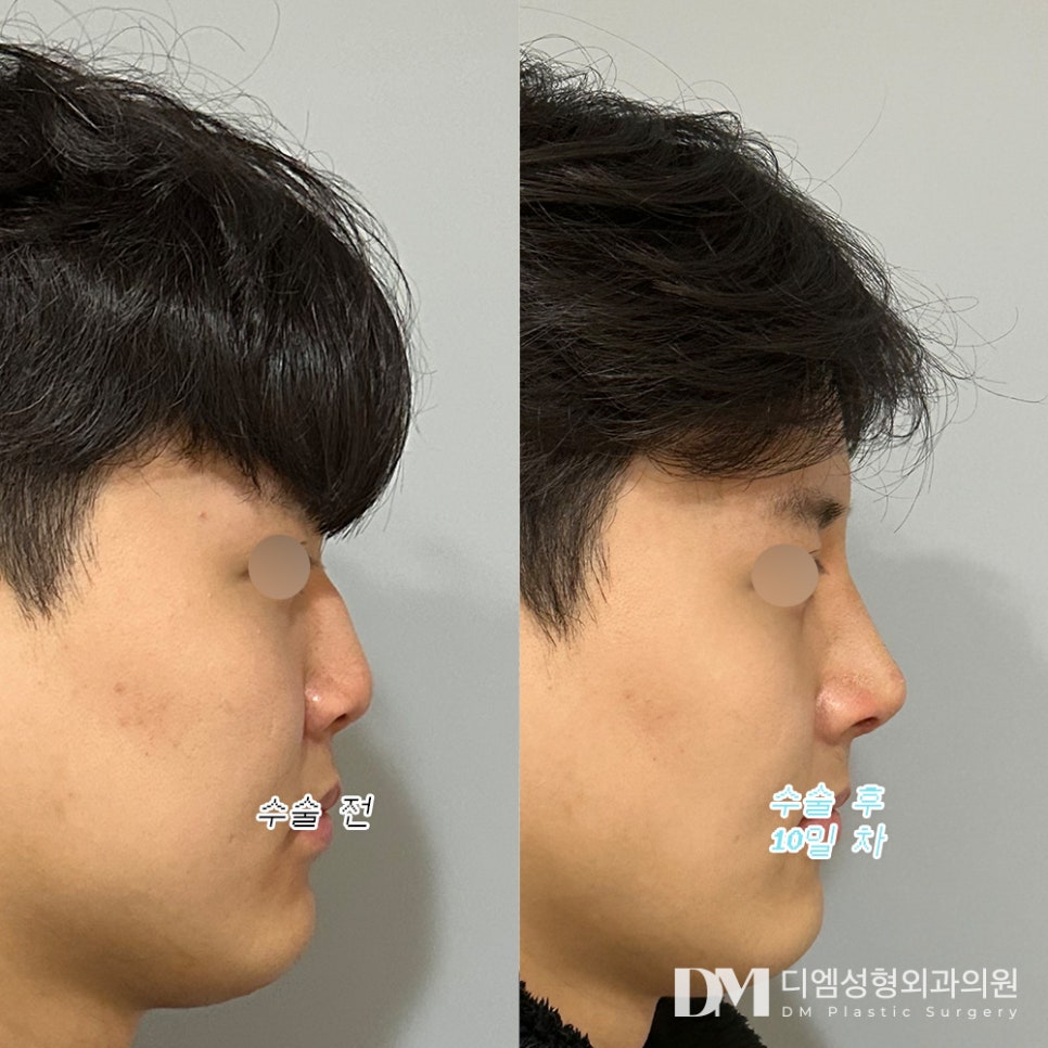Short Nose Surgery: Improving an Awkward Side Profile in a More Three-Dimensional Way image 8