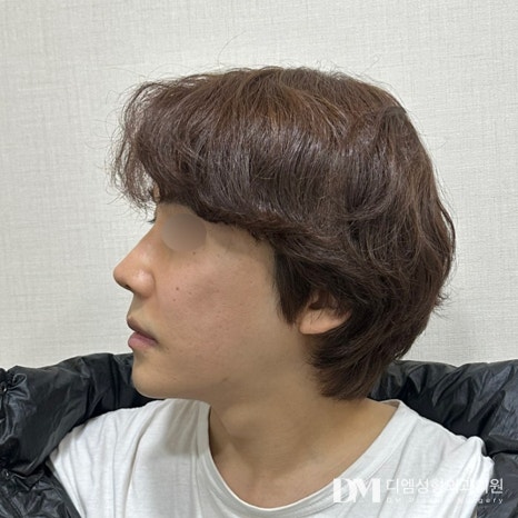 안면거상 후기."통증과 붓기가 없었어요!" 관련 이미지 2