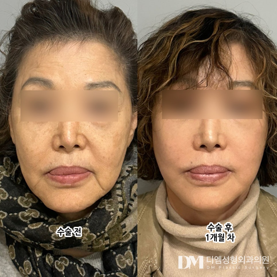 Facelift: Improving Sagging and Wrinkled Skin image 6