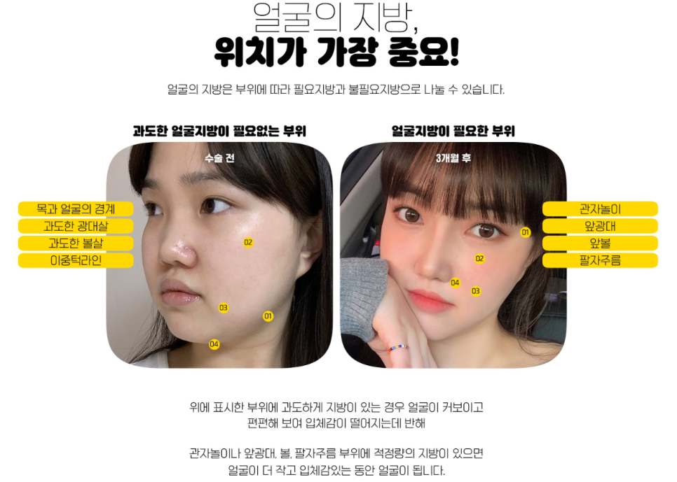 냉동지방이 아닌 생생 지방으로 ! 디엠 얼굴지방이식 관련 이미지 3