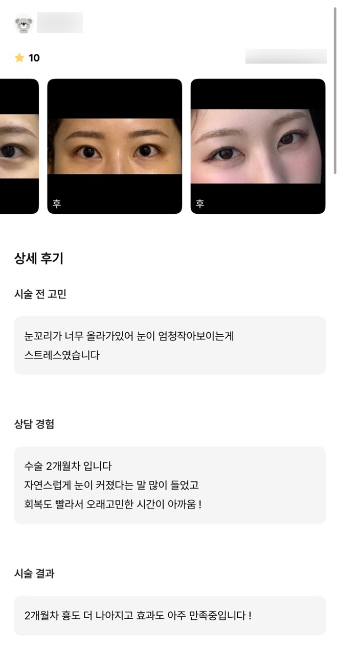 빵트임 후기."회복도 빨라서 오래 고민한 시간이 아까움! " 관련 이미지 1