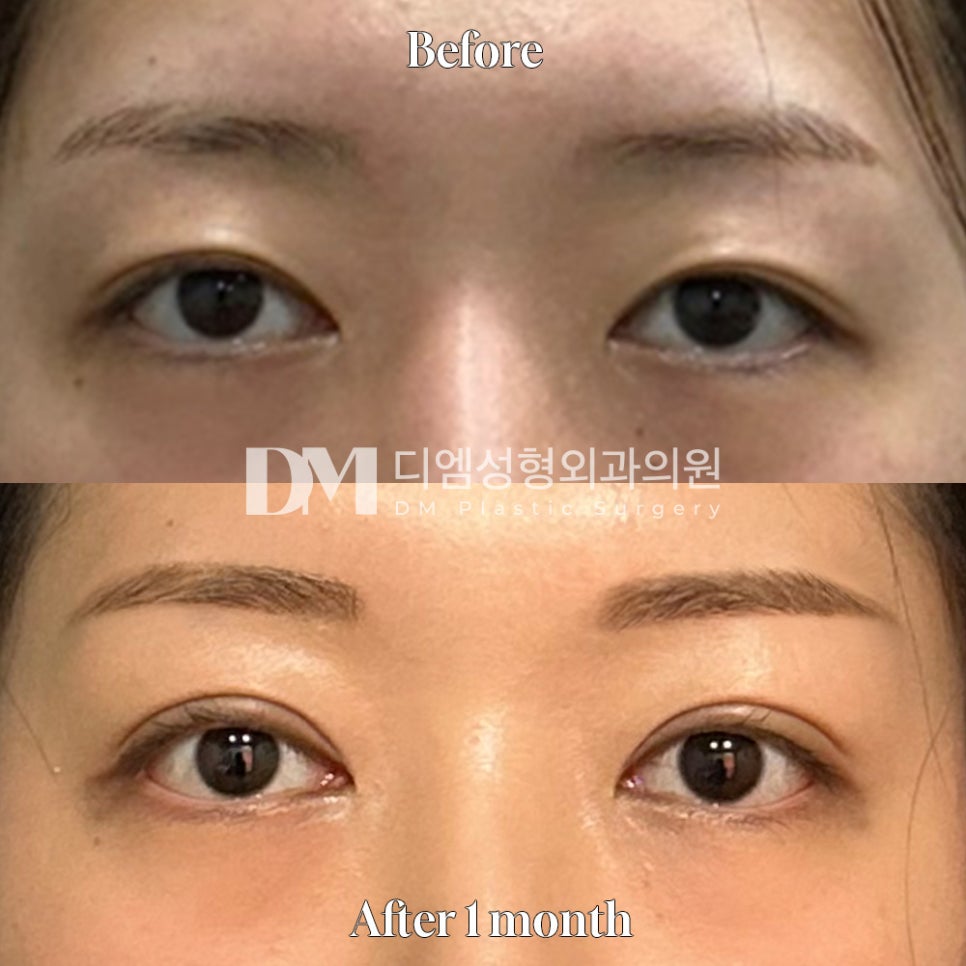 쌍꺼풀수술, 자연스럽고 부드러운 인상 만들기 관련 이미지 10