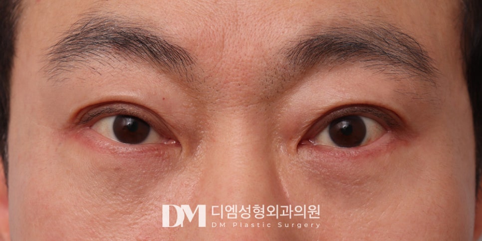하안검, 눈 밑 노화 해결하고 동안되자 ! 관련 이미지 8