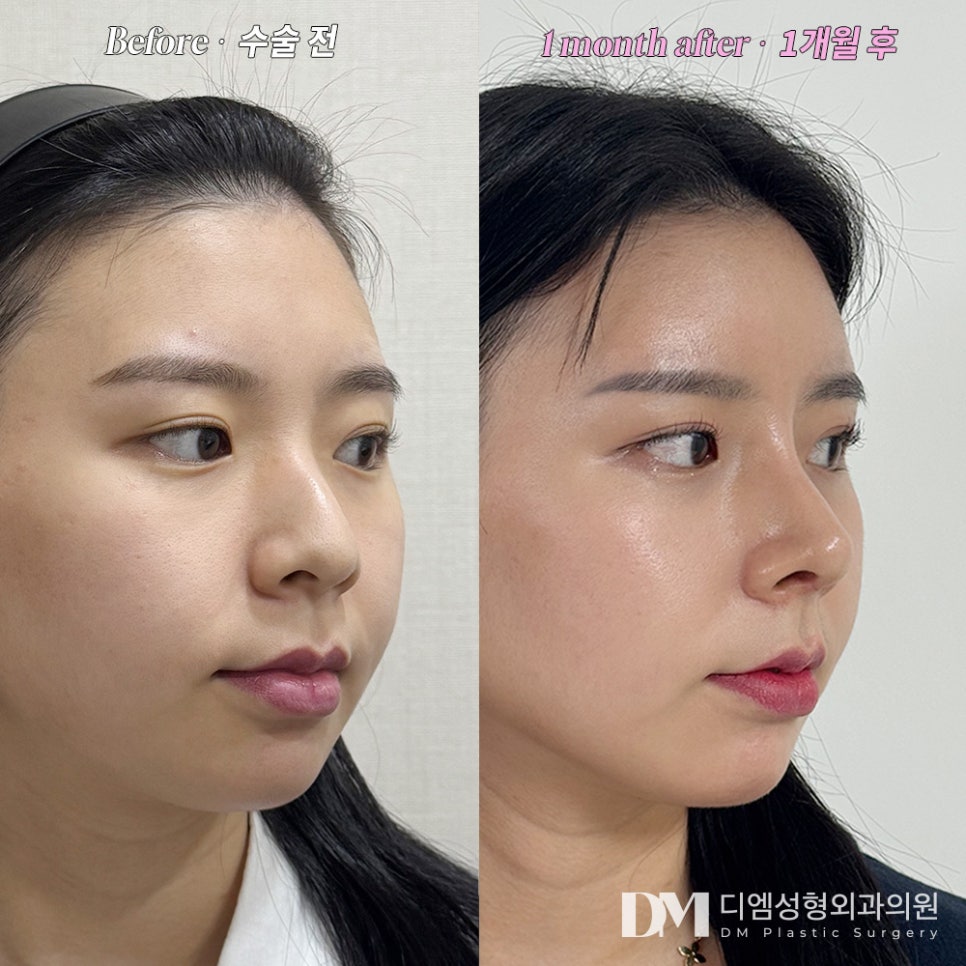 Rhinoplasty Review. “The director immediately understood the look I wanted, so I ended up with such a beautiful, refined nose shape!” image 2