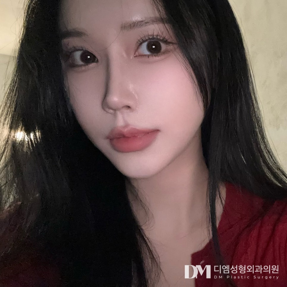 Lateral and Lower Canthoplasty for Softer, Gentler-Looking Eyes?! image 1