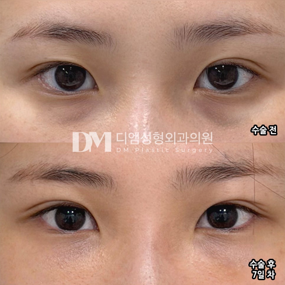 DM Lower Eyelid Fat Repositioning/Lower Eyelid Fat Grafting Surgery Review, “My Tired-Looking Appearance Has Improved a Lot!” image 2