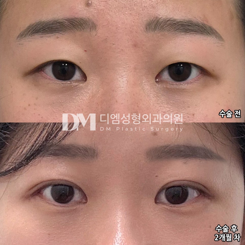 눈재수술, 숙련된 기술로 흉터를 최소화 해 내 것 처럼 관련 이미지 8