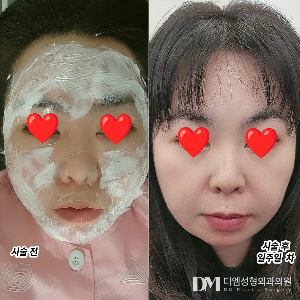 Rejuran Review. “The treatment time is short, there are no side effects, and the results are great, so I highly recommend it!” image 2
