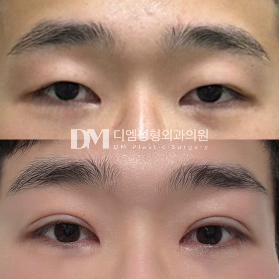 Eye Surgery Review: “I’m happy because my eyes look bigger and the before-and-after difference is significant!” image 2