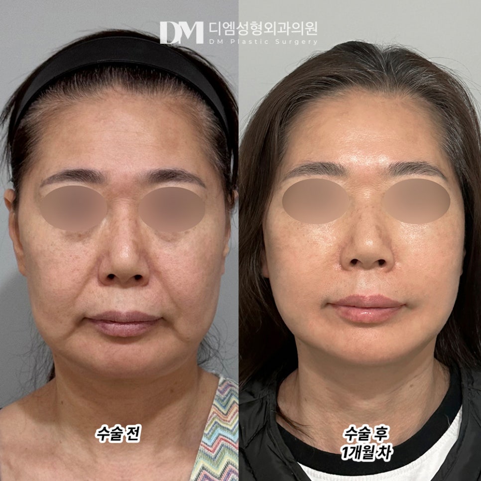 안면거상, 힘없이 늘어진 피부가 고민이라면 관련 이미지 5