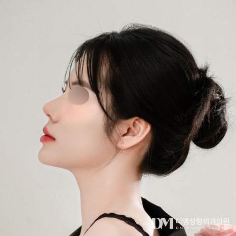 얼굴에 맞는 조화로운 코 끝 성형, 실패하지 않으려면? 관련 이미지 9