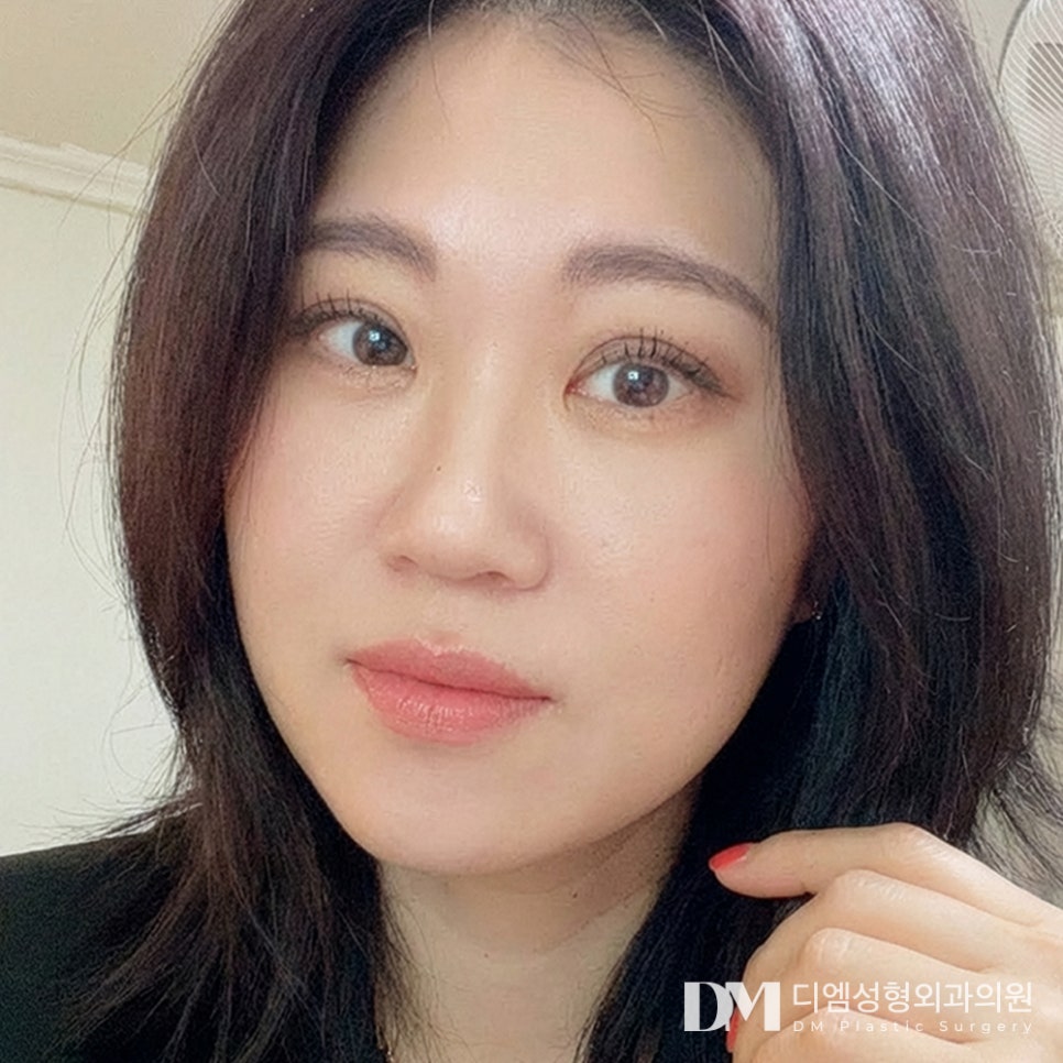 디엠 안면거상 전후사진, 무너진 턱선을 되살리는 핵심은? 관련 이미지 3