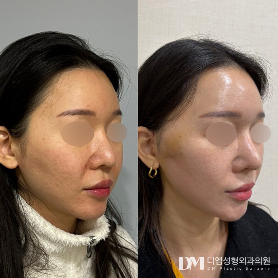 흉터 걱정 덜어주는 반거상술,안면거상과 차이는? 관련 이미지 7