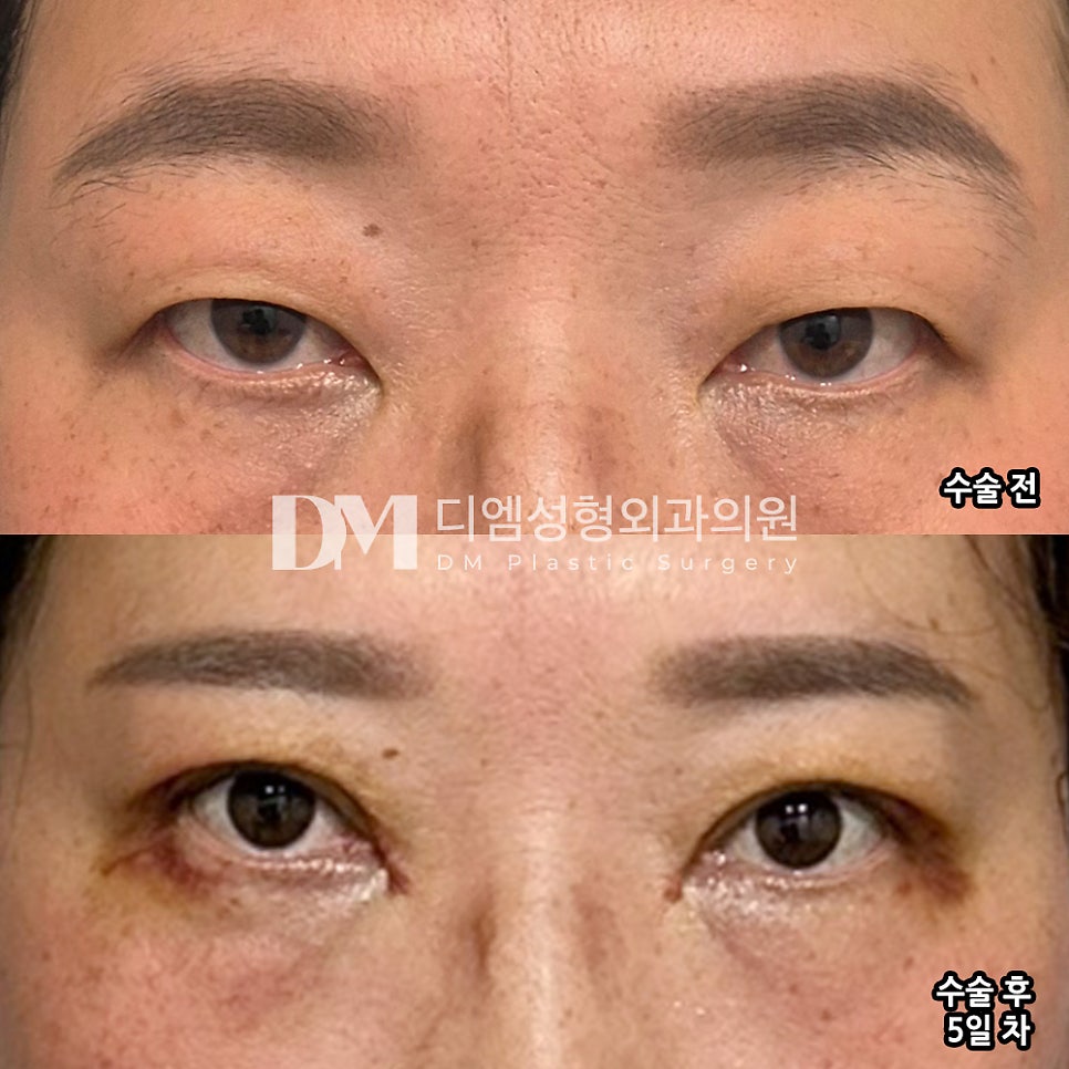 상안검 후기."저는 회복도 빠르고 아픈거 전혀 없었어요 결과도 만족합니다 ~^^" 관련 이미지 2