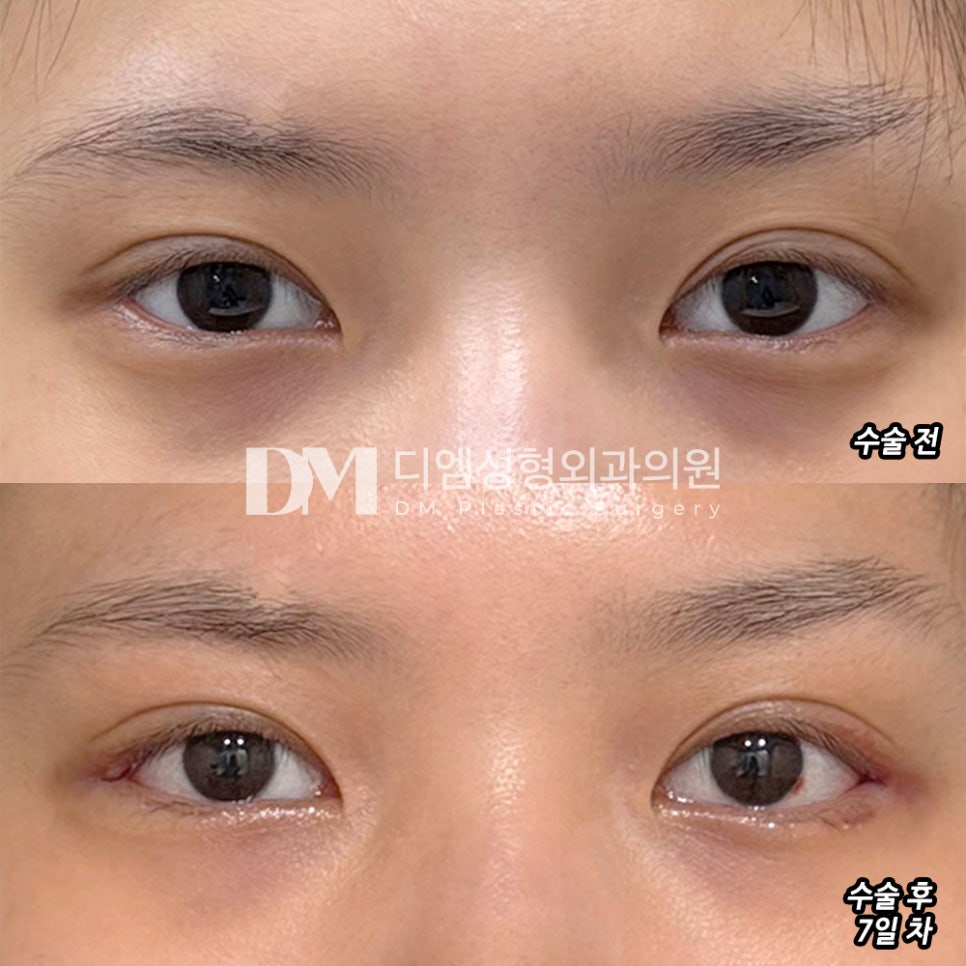 디엠 뒤밑트임 전후사진, 크고 시원한 눈매의 비결은? 관련 이미지 2