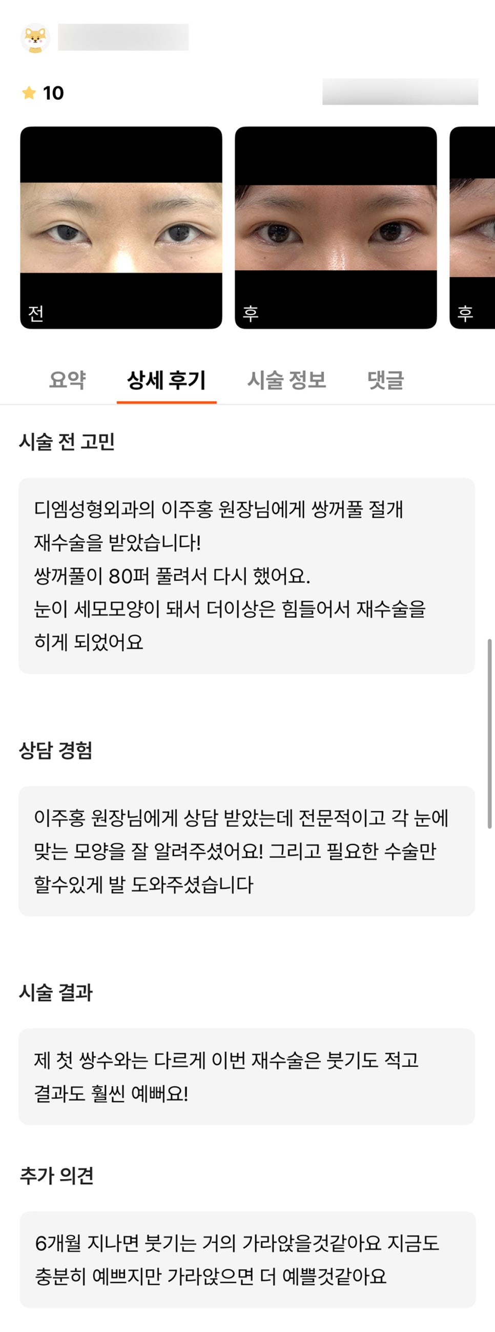 눈재수술 후기."붓기가 가라앉으면 더 예쁠거같아서 기대돼요!" 관련 이미지 1