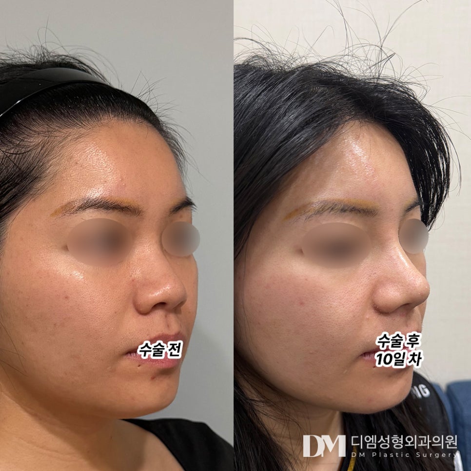 낮은코성형, 쉐딩 메이크업 탈출하자! 관련 이미지 8