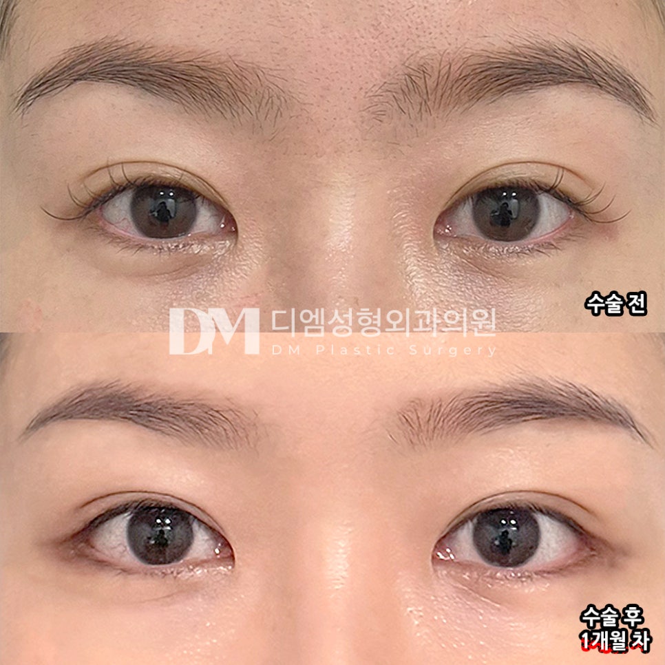 DM Lateral and Lower Canthoplasty Review Photos: Is a Natural-Looking Eye-Widening Effect Possible? image 2