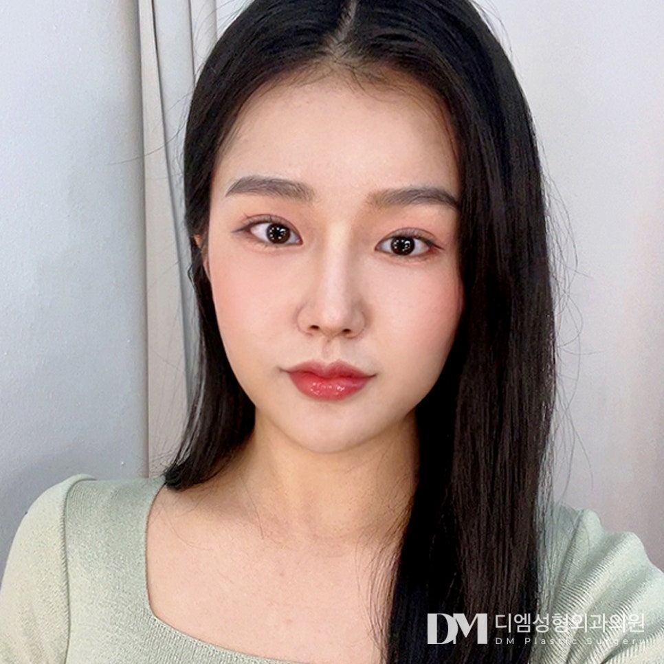 꼬막눈 탈출 가능한 뒤밑트임, 빵트임 회복기간 및 결막부종 총정리! 관련 이미지 2