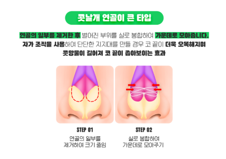 복코성형 , 얼굴의 균형과 조화를 맞춰 관련 이미지 6