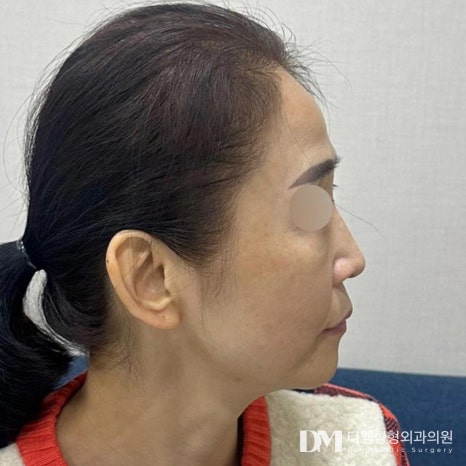 얼굴지방이식 후기."10년은 더 젊어보인다 난리도 아니네요~~" 관련 이미지 2
