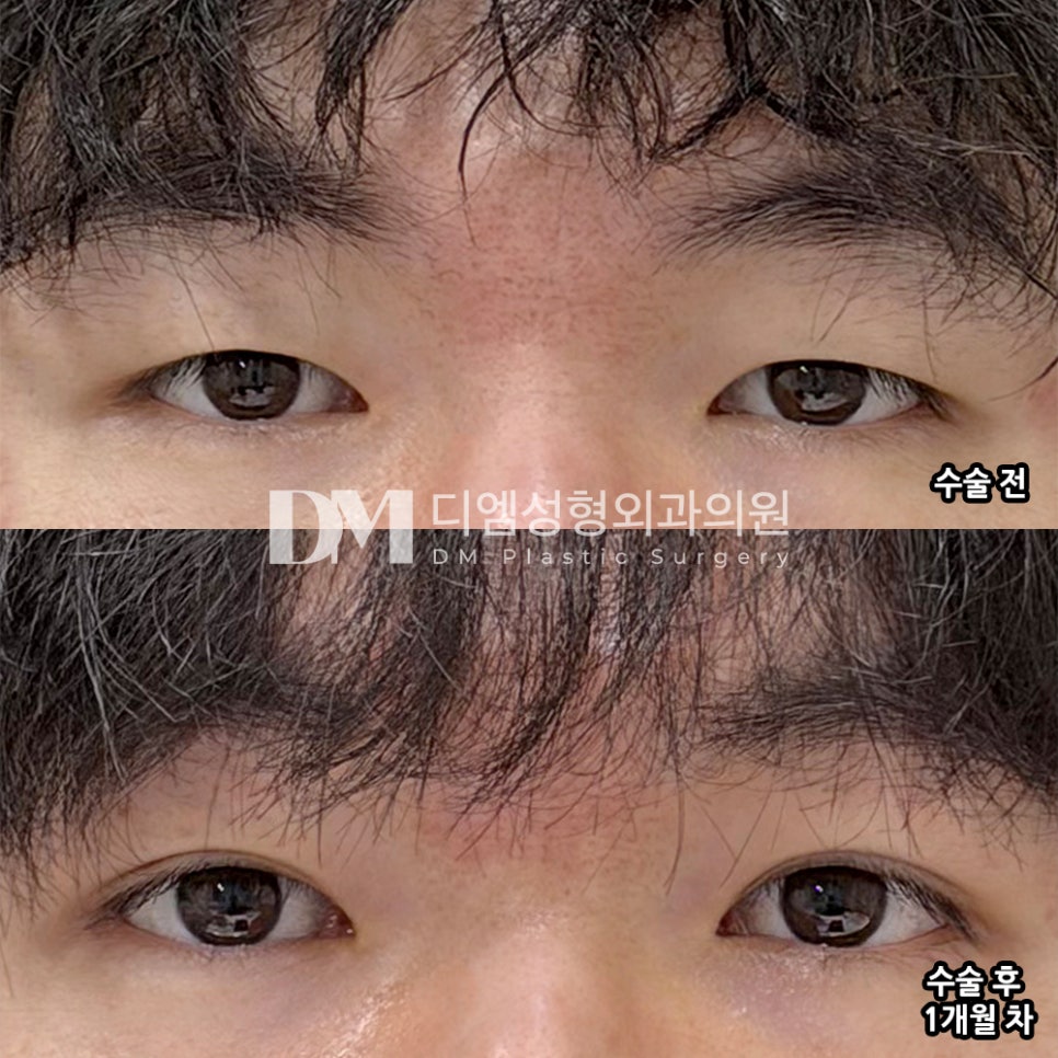 DM Men's Eye Correction Before-and-After Photos, Escape Sleepy Eyes! How to Make Them Look Simple and Clear? image 2