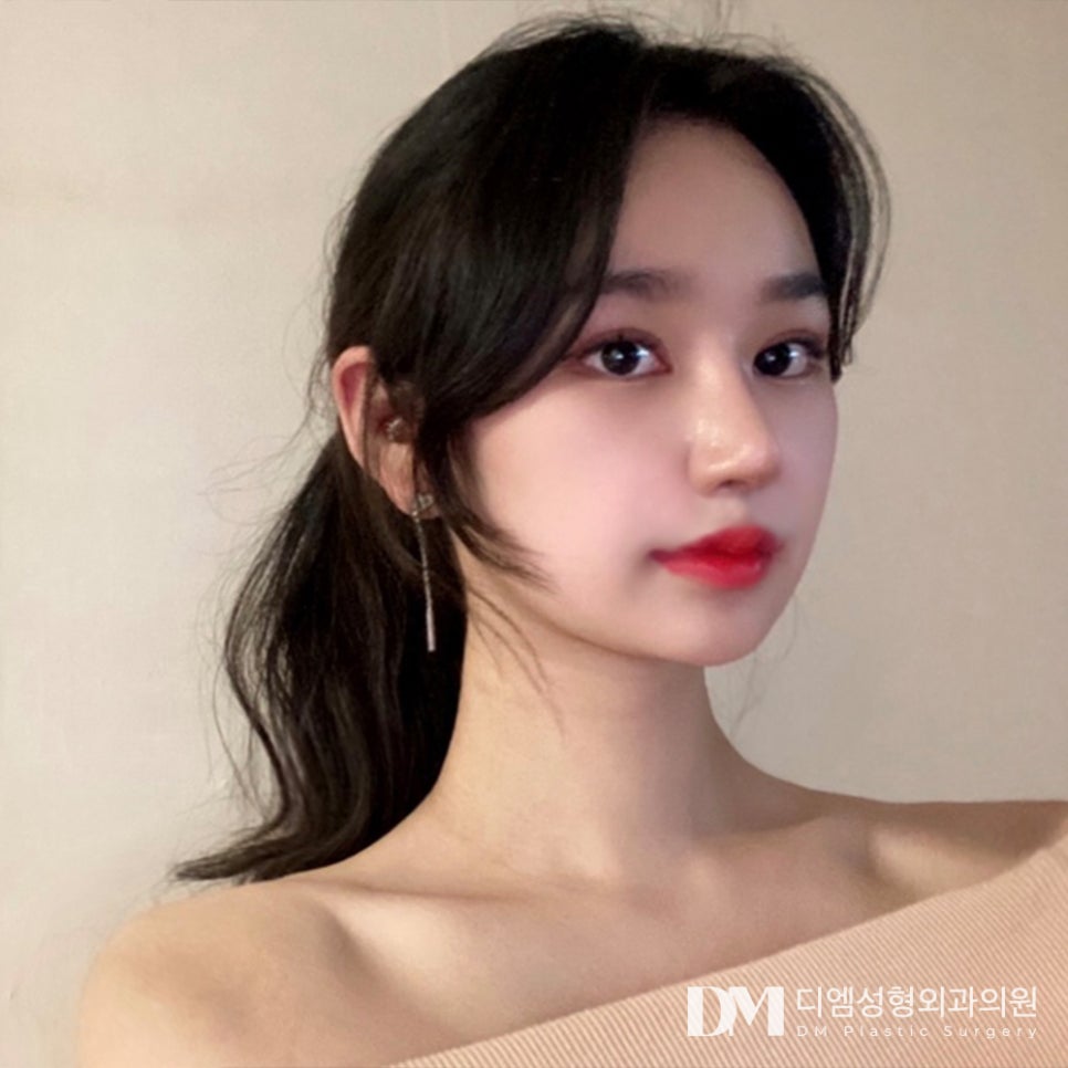 코재수술, 첫코성형 실패 원인 분석이 우선! 관련 이미지 13