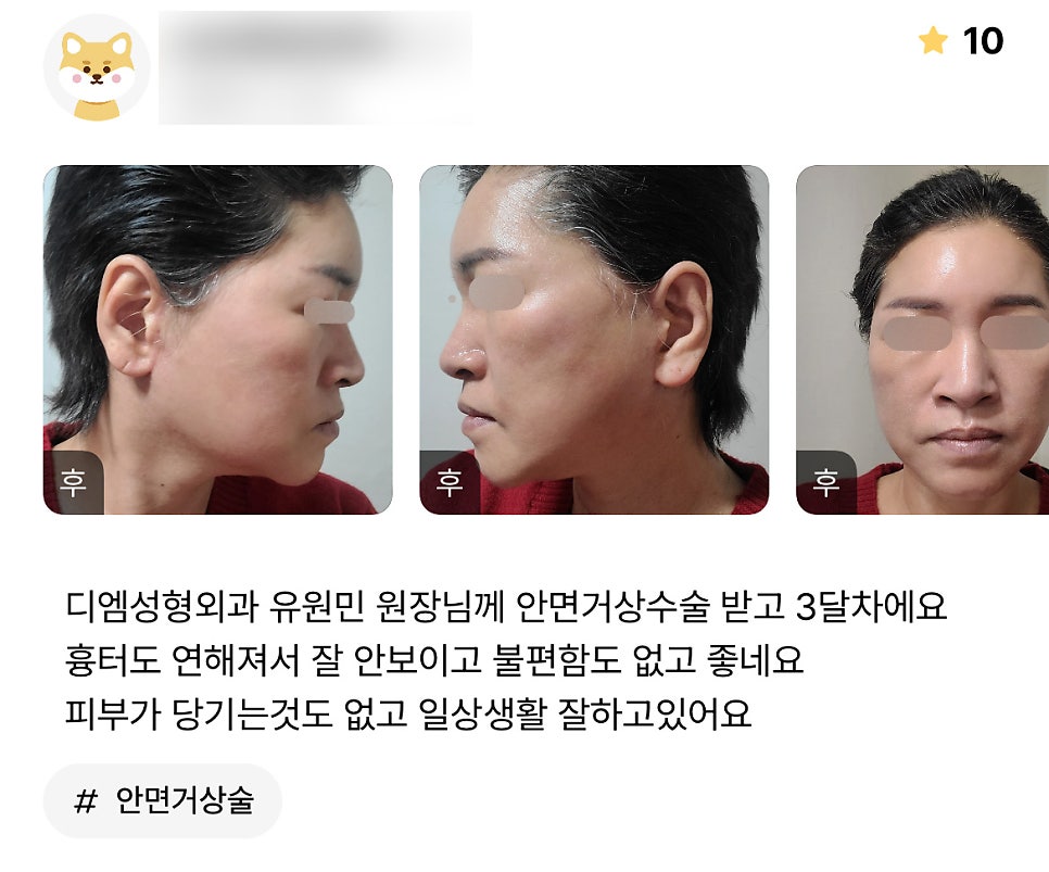 안면거상 후기." 피부 당기는 것도 없고 불편하지 않아서 좋아요!" 관련 이미지 1