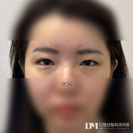 눈재수술 후기."눈 뜨는 것 도 편해지고 자연스러워졌어요!" 관련 이미지 2