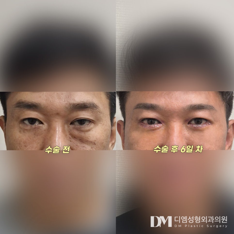 Lower Blepharoplasty: Improving Under-Eye Fat Caused by Aging image 7