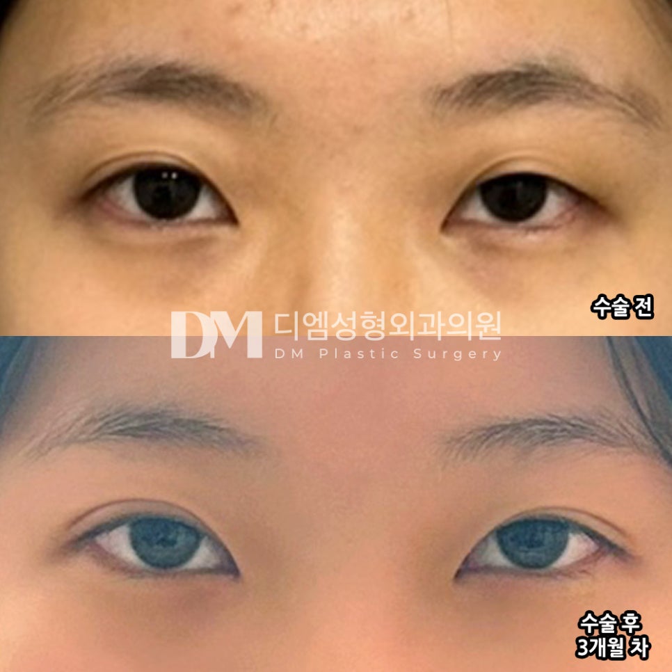 Eye Revision Surgery Review. "It Looks Natural, So I’m Happy with It in My Everyday Life!" image 2