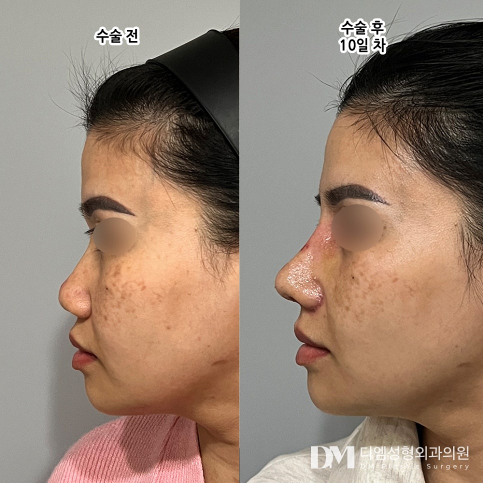 Short Nose Rhinoplasty, Considering Overall Facial Harmony image 8