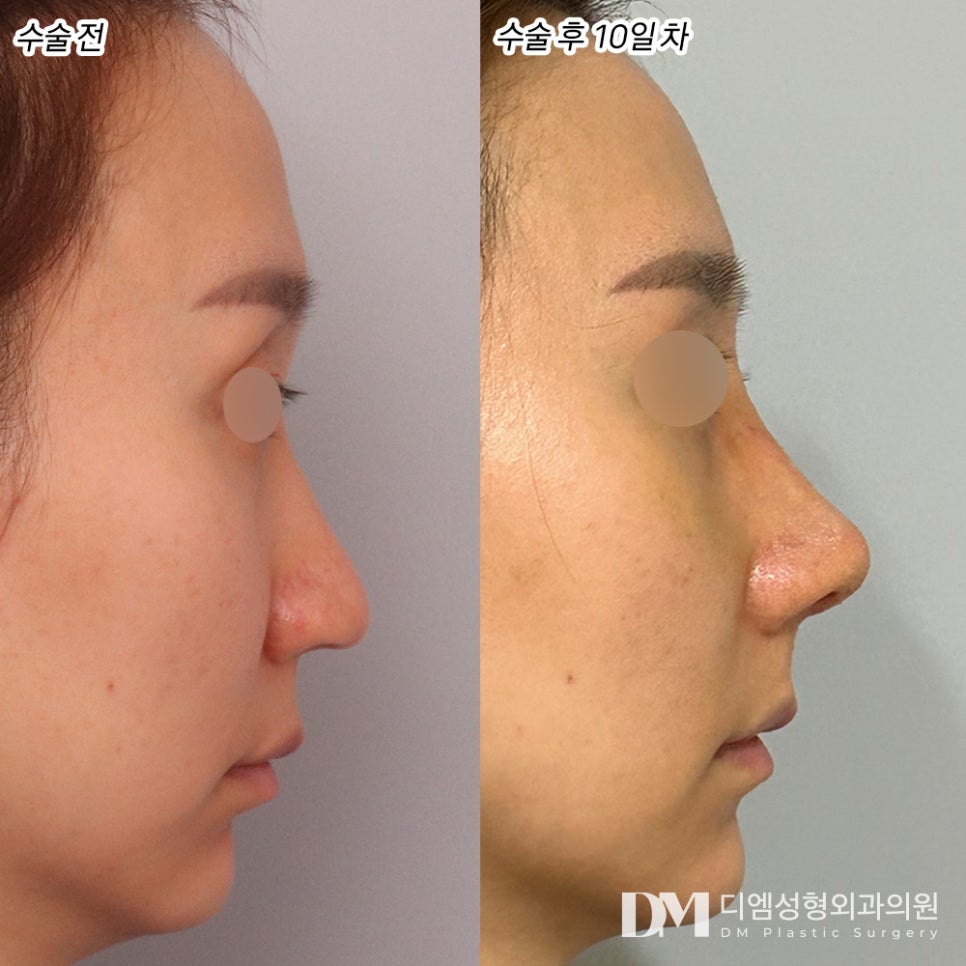 Rhinoplasty for a Hump Nose: What If the Tip Looks Drooped? image 6