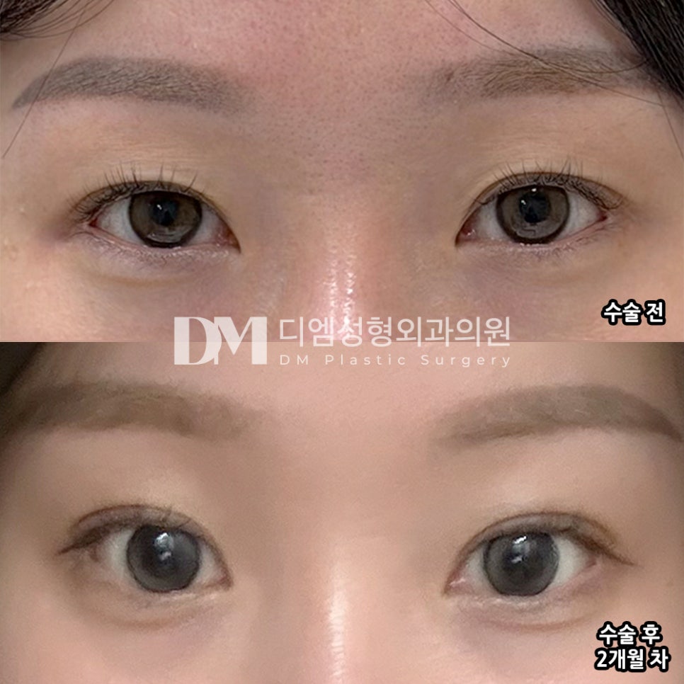 디엠 눈재수술 전후사진, 1차 수술의 실패 원인 분석 후 맞춤 수술이 중요! 관련 이미지 2