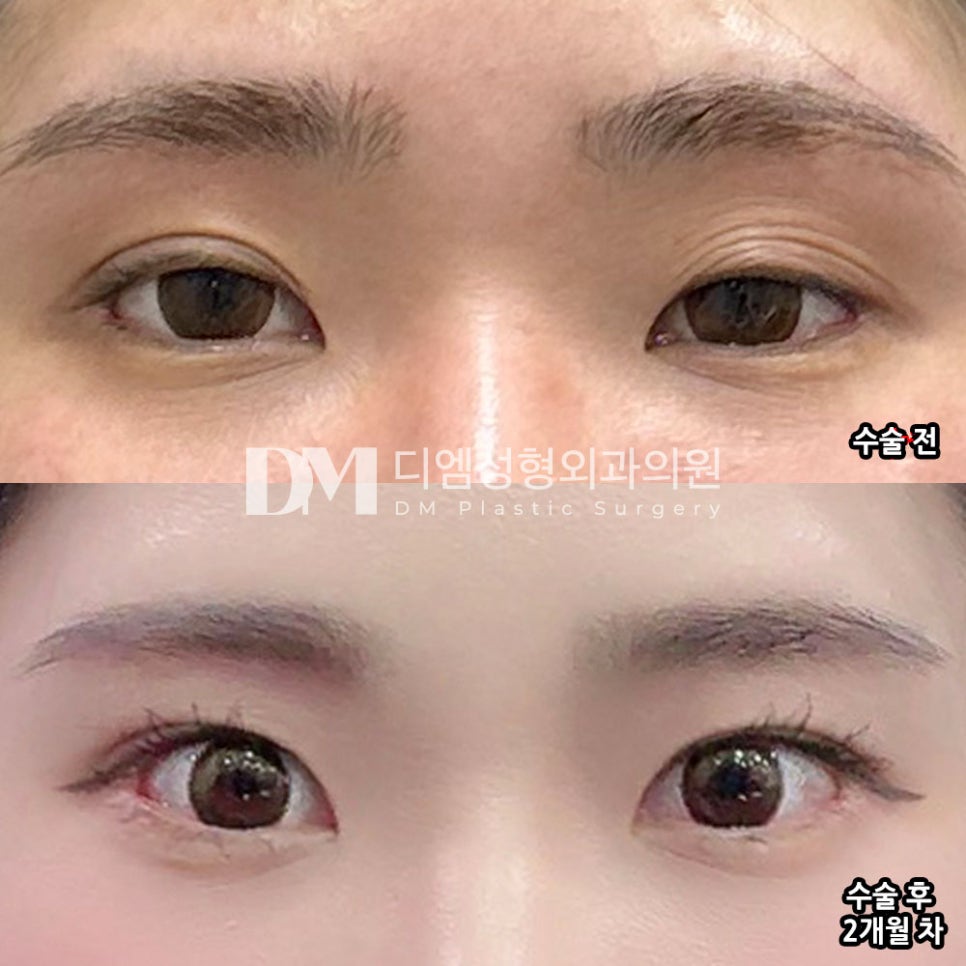 DM Revision Blepharoplasty Review, “Everyone thought I had eaten a lot of ramen the night before!” image 2