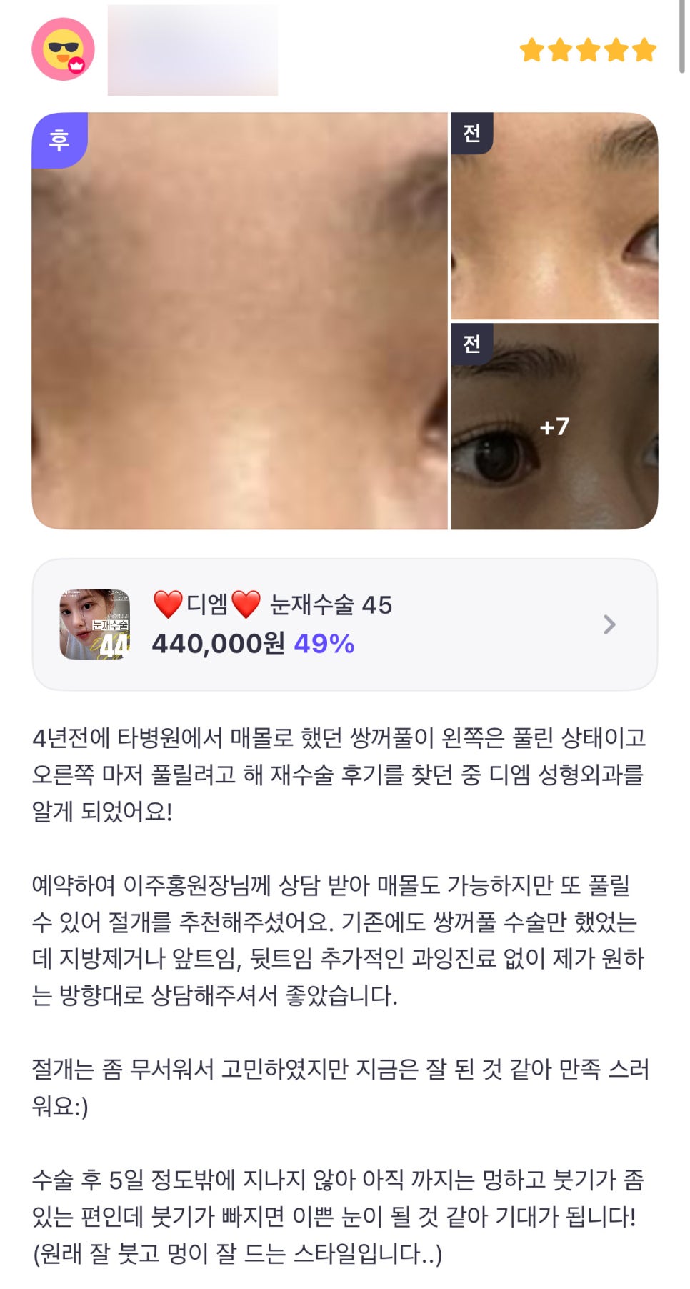 Revision Eye Surgery Review: “I’m looking forward to seeing how pretty it will look once the swelling goes down!” image 1