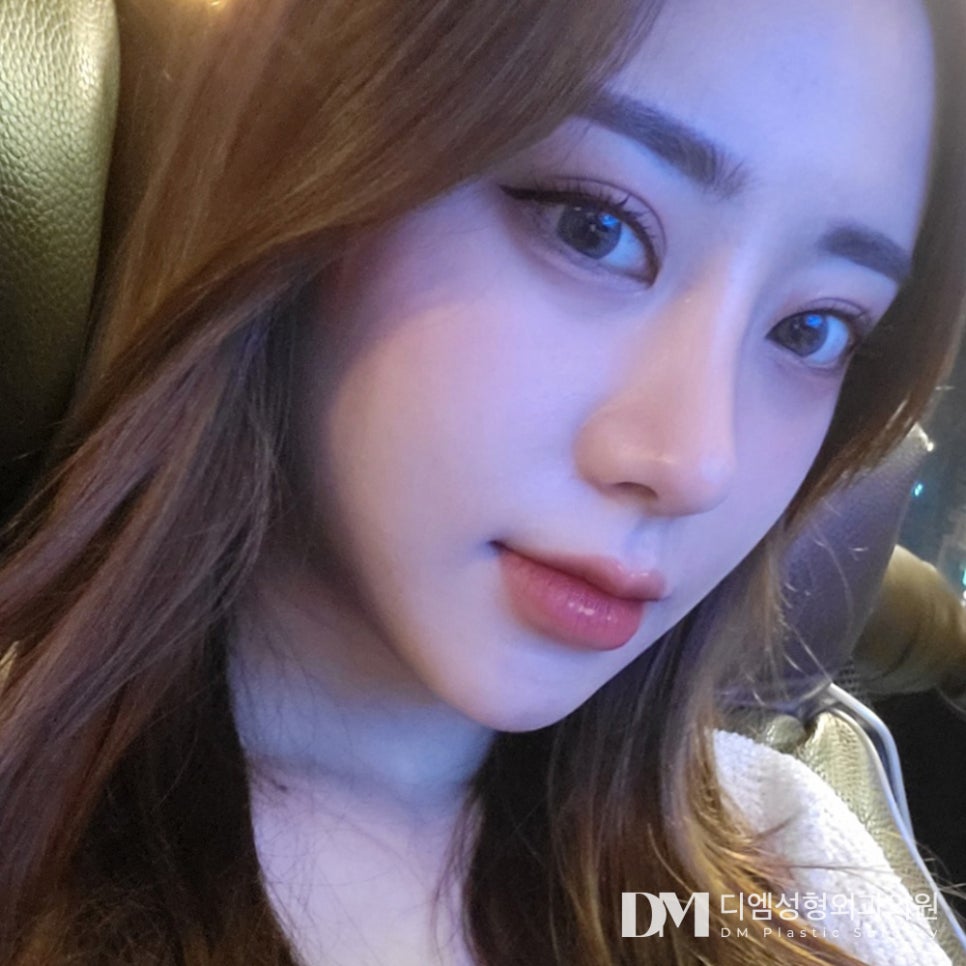 눈재수술 종착지 디엠 ! 관련 이미지 14