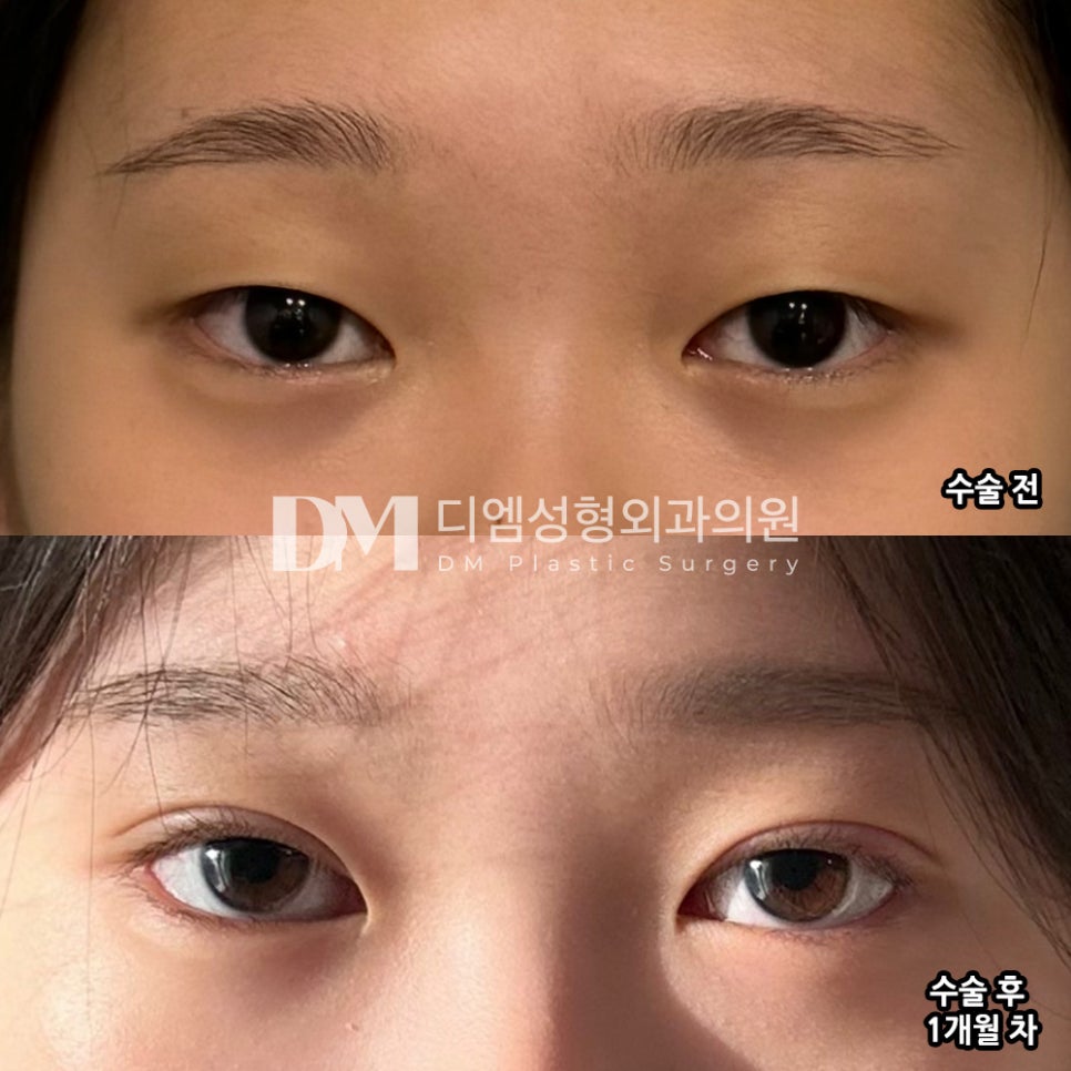 Eye Surgery Review: “There’s less swelling than I expected, and the crease looks nice too. I’m satisfied.” image 2
