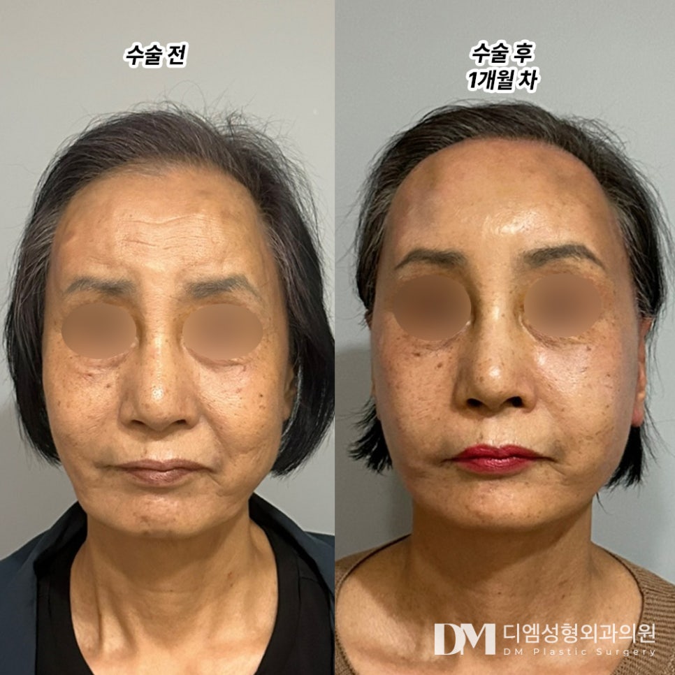 Facelift Review. “I was happy to feel myself becoming younger!” image 2