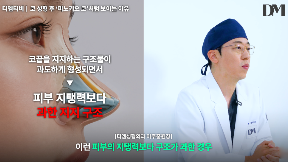 코성형 후 피노키오 코처럼 보이는 이유, 코가 높아서일까요? 관련 이미지 5