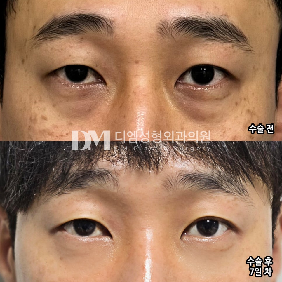 눈밑지방재배치, 어둡고 나이들어 보이는 인상 안녕! 관련 이미지 6