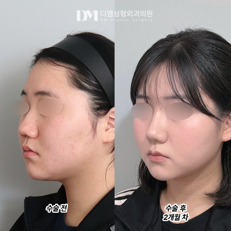 DM Rhinoplasty Before-and-After Photos: Say Goodbye to a Bulbous, Wide Nasal Tip! image 2