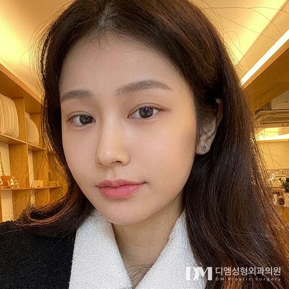 디엠 뒤밑트임 전후사진, 답답한 눈매가 달라지는 방법 관련 이미지 3
