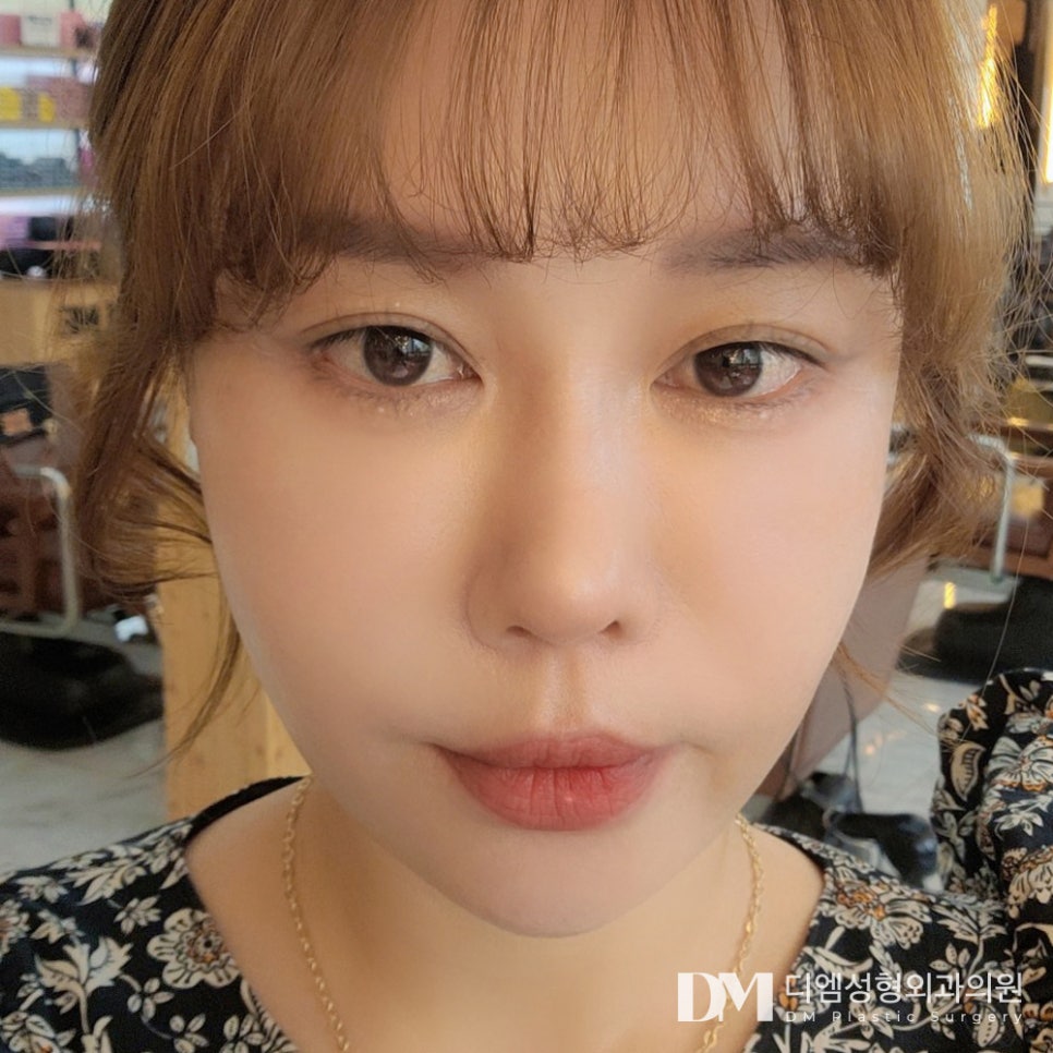Nasolabial Folds That Make You Look Older: Improve Them Smoothly with a Half Facelift image 1