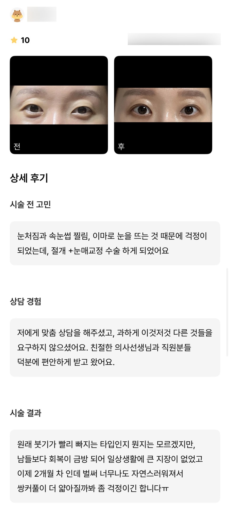 눈성형 후기."너무나도 자연스럽고 남들보다 회복이 금방 되어 일상 생활에 큰 지장이 없었어요!" 관련 이미지 1