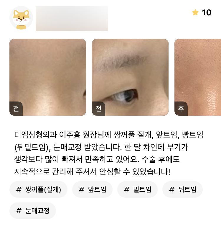 눈성형 후기."수술 후에도 지속적으로 관리해 주셔서 안심할 수 있었습니다!" 관련 이미지 1