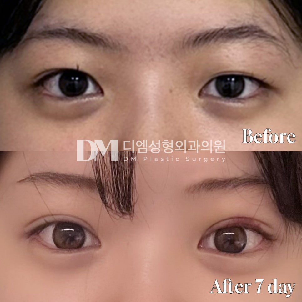 Revision Eye Surgery Review. "I was glad they consulted carefully to match my eyes!" image 2