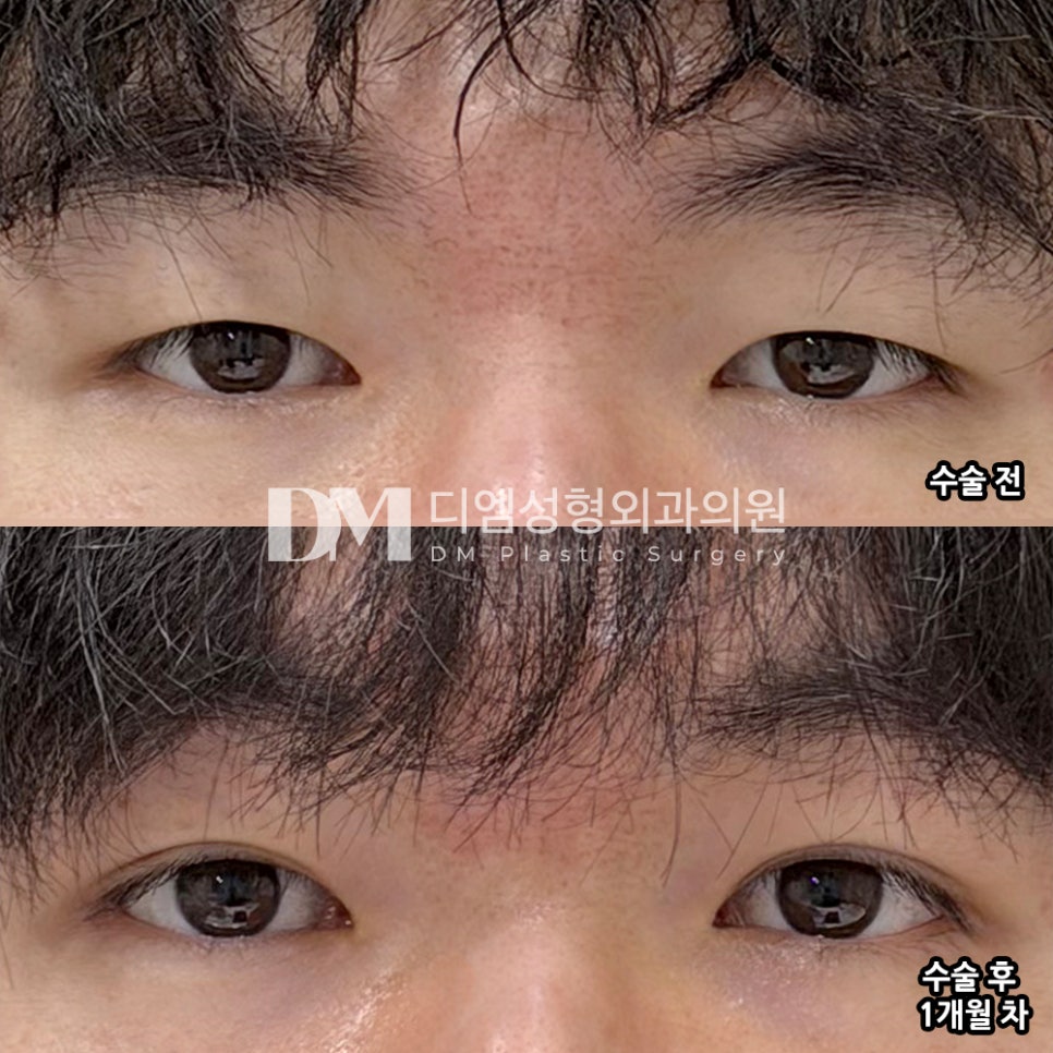 디엠 남자눈매교정 후기, “주변에서 눈이 또렷해졌다고 합니다!” 관련 이미지 2