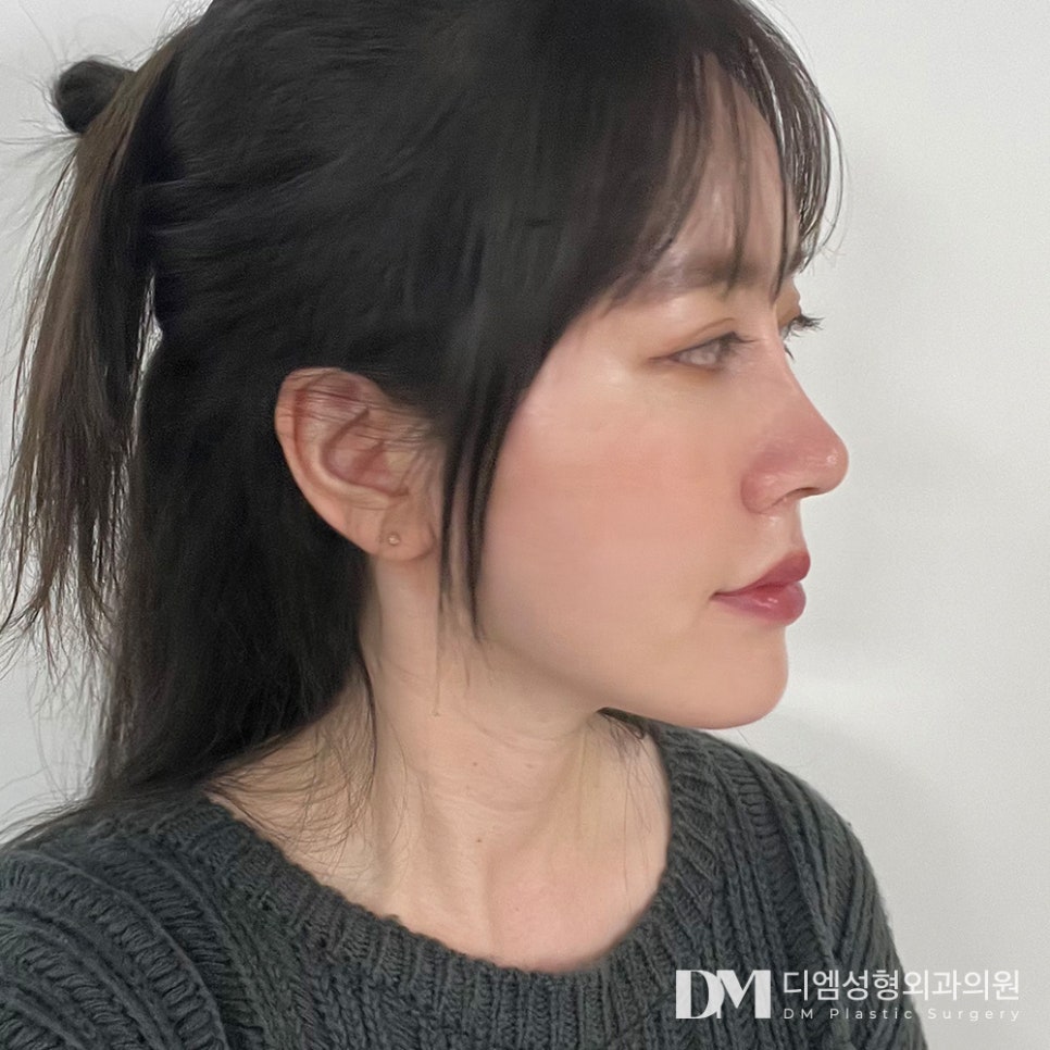 코재수술, 제대로 알자! 관련 이미지 14