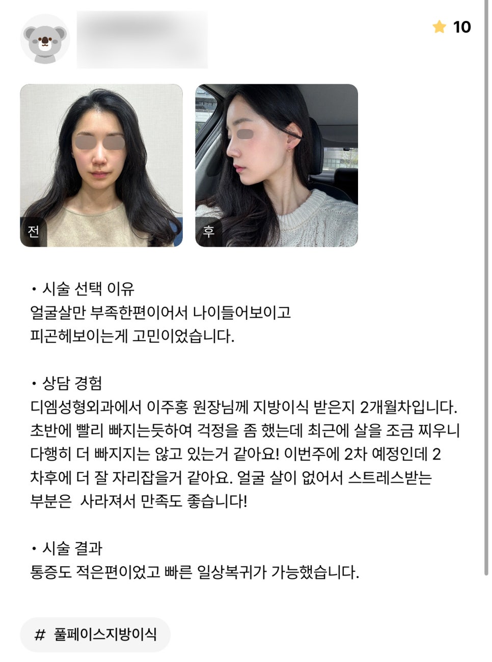 얼굴지방이식 후기."얼굴 살이 없어서 스트레스 받는 부분은 사라져서 만족도 좋습니다! " 관련 이미지 1